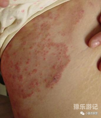 如何判断是阴囊湿疹还是股癣，一篇全面指南怎么判断阴囊湿疹和股癣