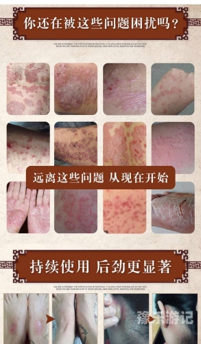 如何判断是阴囊湿疹还是股癣，一篇全面指南怎么判断阴囊湿疹和股癣